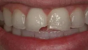 Diente roto (fractura dentaria).