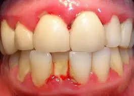 Dientes con enfermedad periodontal