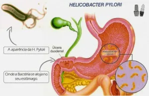 Monografia de Helicobacter Pylori