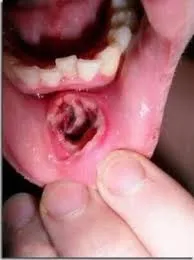 Labio con un agujero debido a una infección.