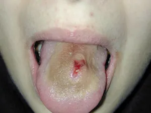 Lengua inflamada con absceso con sangre.