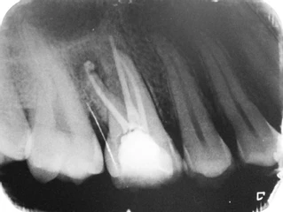 Radiografía endodoncia