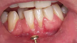 Recesión gingival.